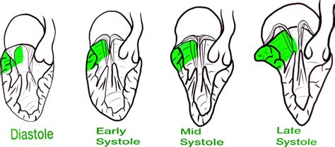 basal inferior wall akinesis.